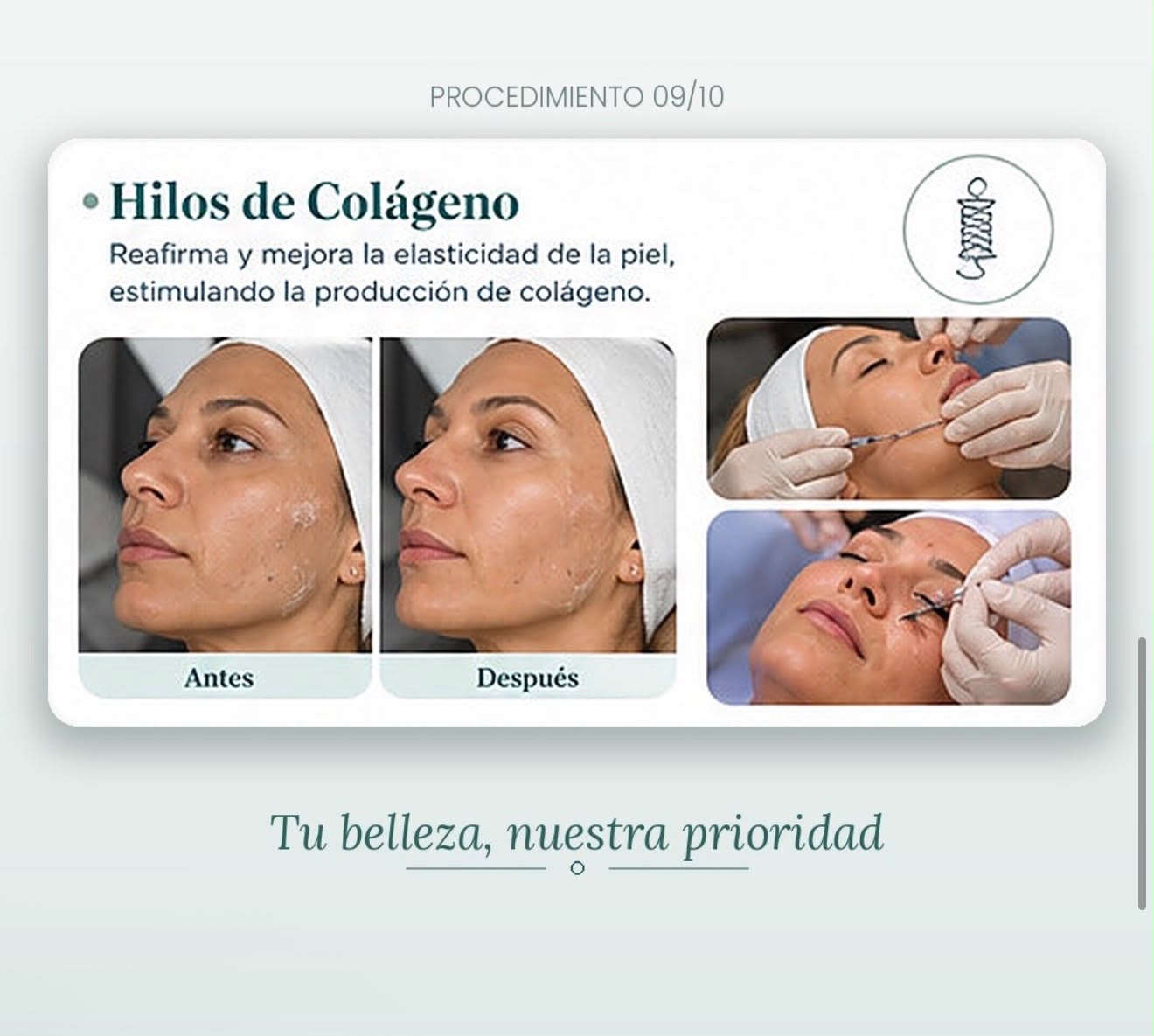 Información visual sobre el procedimiento con hilos de colágeno