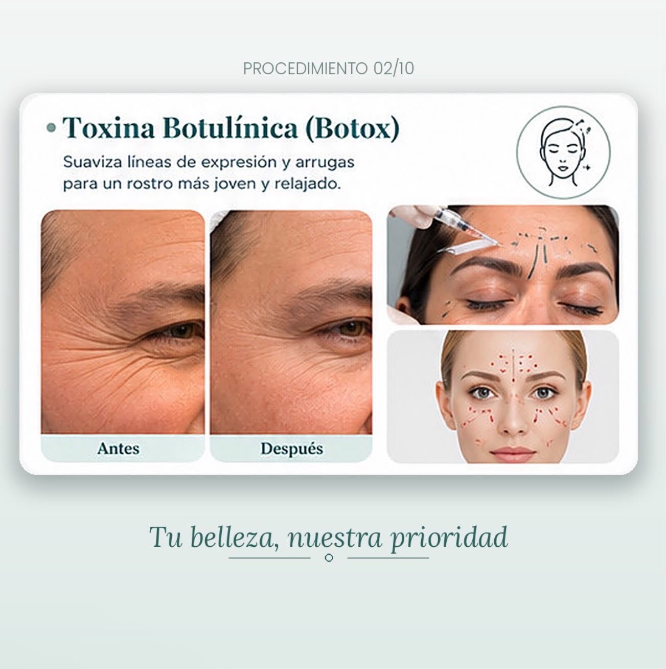 Información visual sobre el procedimiento de toxina botulínica